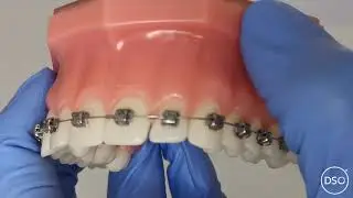 Moving a wire back using stops on the wire