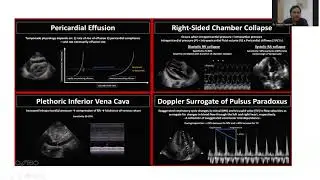 POINT OF CARE ULTRASOUND IN SHOCK - Dr SWARNA DEEPAK K