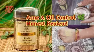 Khadi Sandalwood Face Pack Review 🌿 | Acne, Pimples & Oil Control | The Truth About Pimple Removal