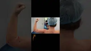 360&deg; Arm Liposuction | Celebrity Arms&trade; | Immediate Results | Expert Dr. Thomas Su | Artlipo