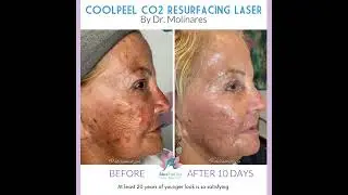 Anti-aging Transformation with our CoolPeel