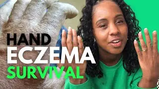 ECZEMA ON HANDS SURVIVAL KIT | How I Treat Dyshidrotic, Red, Inflamed & Dry Cracked Skin 🧴🧂