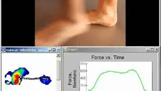 MatScan Barefoot Pressure Measurement and Gait Analysis for Physical Therapy in New York City (NYC)