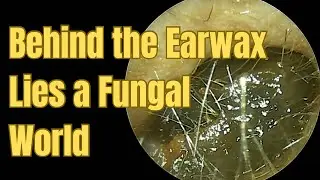 Behind the Earwax Lies a Fungal World