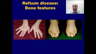 Introduction to Adult Refsum Disease