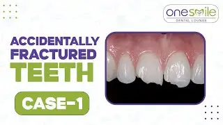 Accidental Tooth Fracture in a 7-Year-Old 🪥 | Full Case Study