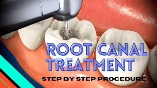 Root Canal Treatment procedure Step by Step | animation video | RCT | your dentist | dando estetica