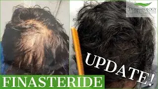 Topical Finasteride for HAIR LOSS - Before and After! - Los Angeles - Dr. Ben Behnam