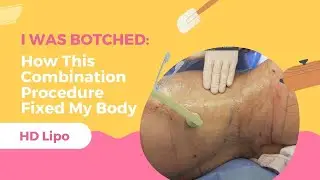 I WAS BOTCHED: How This Combination Procedure Fixed My Body| HD Lipo | Dr. Jason Emer