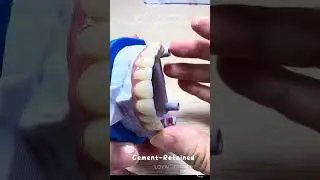China dental Lab outsourcing - Cobalt-Chromium Porcelain-Fused-to-Metal Implant &middot; Cement-Retained