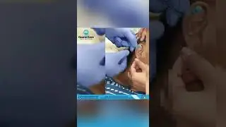 Dr. Umesh Bilewar talking about Safe Earlobe piercing at Ozone Care Hair & Skin Clinic
