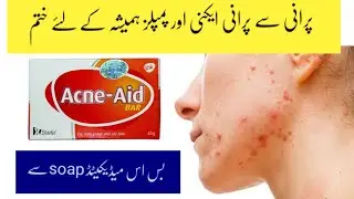 Acne - Aid Soap | Best medicated soap for oily and acne skin