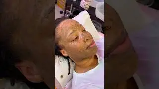 How to get rid of hyperpigmentation with treatments | Bio Peeling Treatment In London
