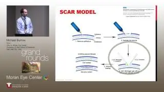 Stem Cell Therapy for Corneal Scarring