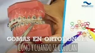 Gomas ortodoncia ¿Cómo y cuándo se colocan?