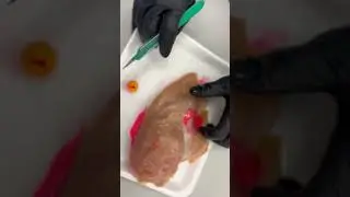Abscess Drainage