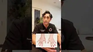 Are bulging hand veins a medical issue?