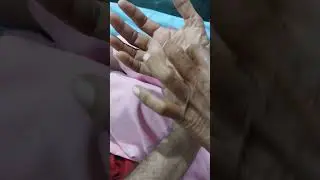Carpal tunnel syndrome Part 3 in Telugu Durkans test #shorts