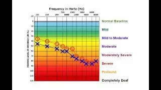 Audiogram Immittance