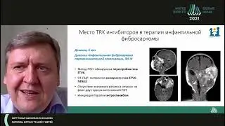 Инфантильная фибросаркома у детей