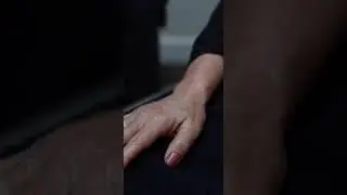 IPL Laser Treatment for Hands: Ultimate Hand Rejuvenation for Dark Spots & Red Spots from Sun