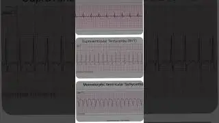 E C G  ELECTRO CARDIO GRAM 🫀 #shortvideo #doctor #youtubeshorts #lifeisbutadream #doctor #shortvideo
