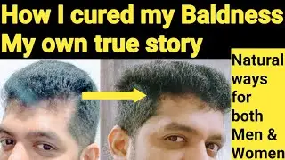 முன் நெற்றியில் முடி ஏறி கொண்டே செல்கிறதா?Hair Growth Tips for forehead in Tamil/Stop Hairfall Tamil