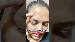 Forehead bumps & acne removed in 3 days ✅