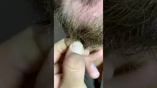 is your hair really falling out? #asmr #satisfying #ingrown #shorts