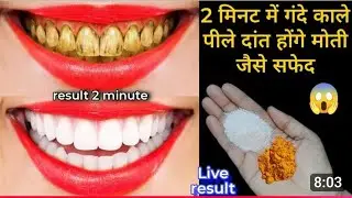  This home remedy will make your yellow and dirty teeth shine like pearls in just 2 rupees / Teeth