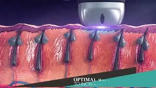 SHR 3D Technology  - Soprano laser hair removal