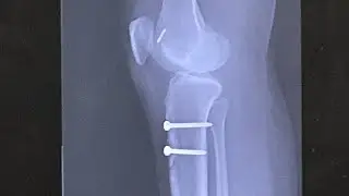 What to expect when you are expecting MPFL reconstruction surgery 😳