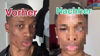 CHEMISCHES PEELING!