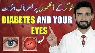 Eye Problems Due to Diabetes|Sugar Ka Aankhon Par Asar|Diabetic Retinopathy Treatment in Urdu