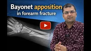 What is a bayonet apposition? Dr Soundar I Tamil