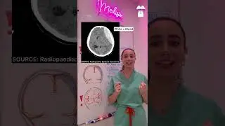 Medisin - Brain Bleeds / Cerebra Hemorrhages - Epidural, Subdural, Subarachnoid hemorrhages
