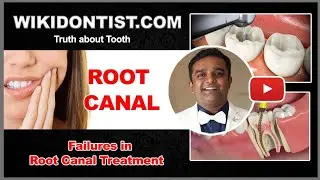 Failures in Root Canal Treatments / Dr.Thomas Nechupadam