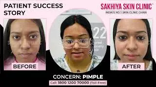 Real Acne Scar Treatment Success Story | Best Clinic for Acne Scar Removal | Sakhiya Skin Clinic