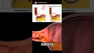 Gambaran penyakit GERD  #gerd #esophageal #kerongkongan #kesehatan #short #biologi #medis