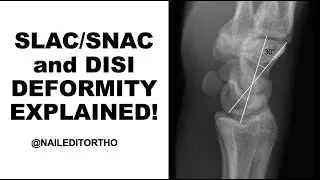 What is SLAC and DISI deformity??