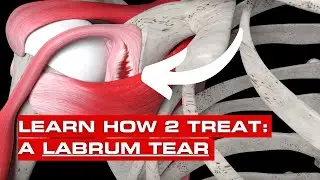 Labrum Tear Injuries: Causes, Symptoms, and Recovery | Episode 2