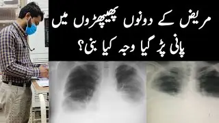Bilateral Pleural Effusion| Dono Lungs mn Pani| پھیپھڑوں میں پانی پڑ گیا۔