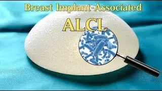 The Truth Regarding Breast Implant-Associated ALCL