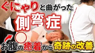 【衝撃のビフォーアフター】ぐにゃりと曲がった側弯症。お腹の癒着剥がしで奇跡の改善！