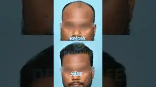Hair Transplant Result After 7 Months | Boosted Confidence with Boosted FUE Technique