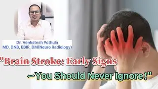 Brain Stroke: Recognize the Warning Signs, Fast Treatments & Life-Saving Precautions!