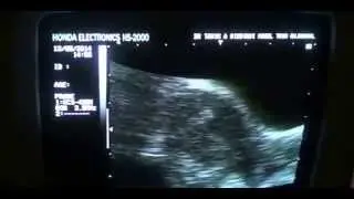 echogenic areas in endometrial canal mimicking IUCD