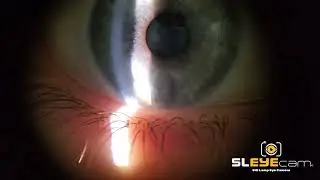 SLEYEcam evaluating a soft toric contact lens on a patient.