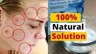 How Does Baking Soda Get Rid of Acne Scars | 100% Natural Remedy | Acne Treatment
