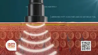 Redefine your shape and renew your confidence with Cellsound body contouring at Nuvell Clinics